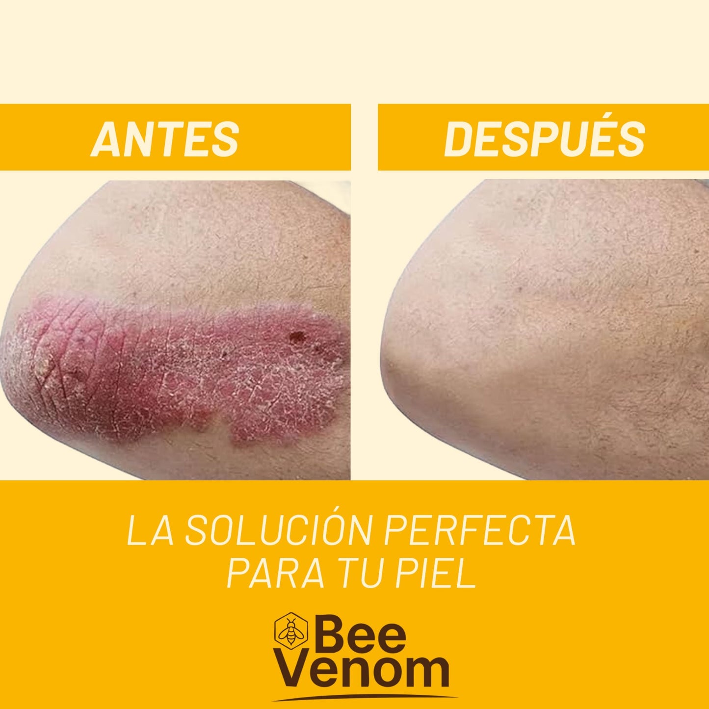 Bee Venom Spray: Alivio inmediato para piel sensible con Psoriasis.