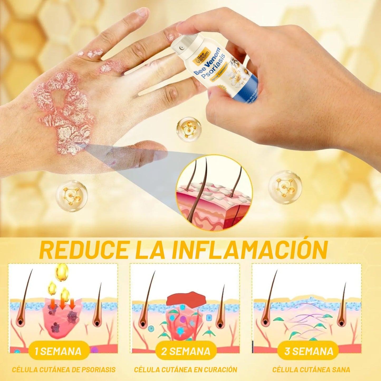 Bee Venom Spray: Alivio inmediato para piel sensible con Psoriasis.