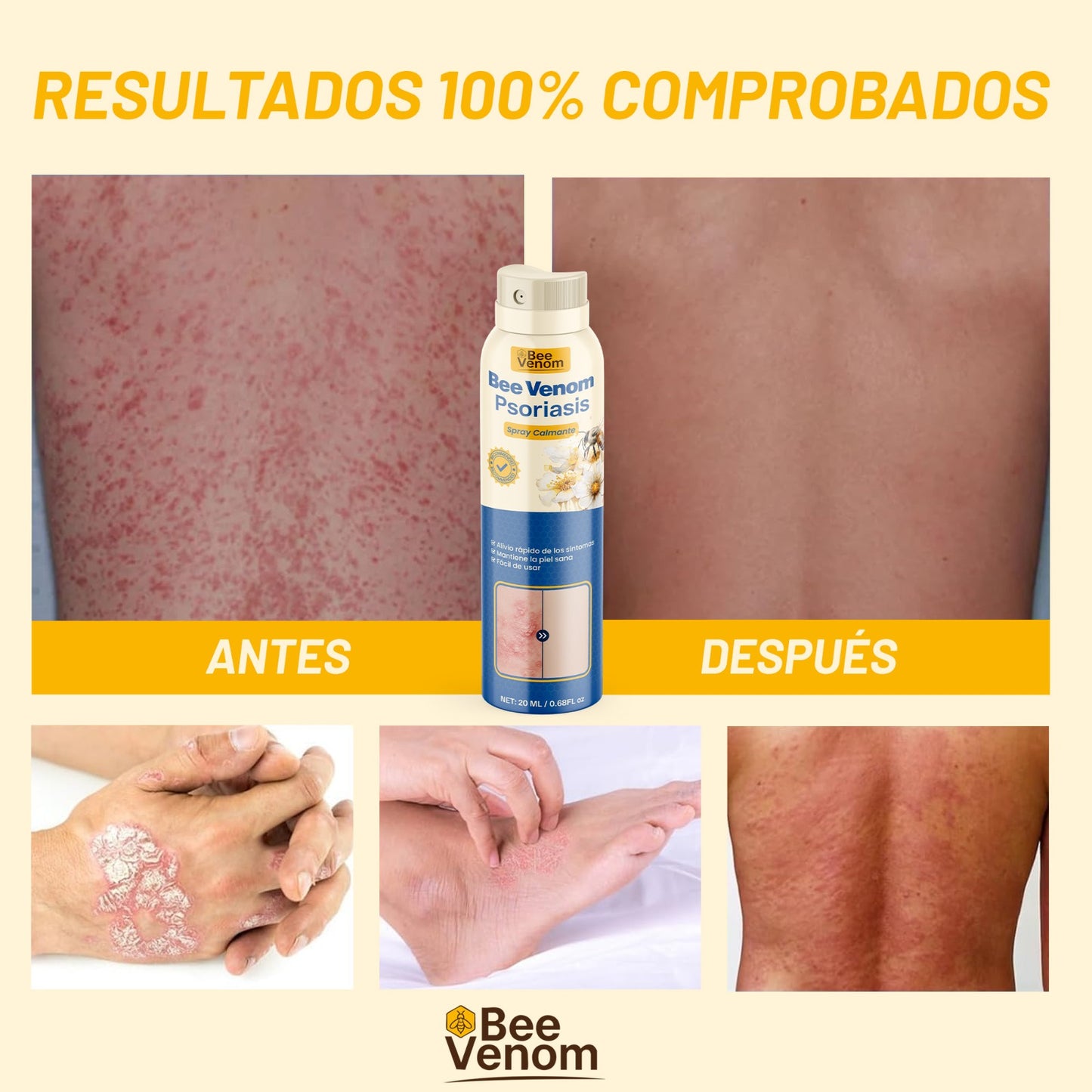 Bee Venom Spray: Alivio inmediato para piel sensible con Psoriasis.